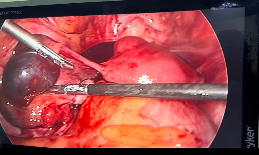 Ectopic Pregnancy