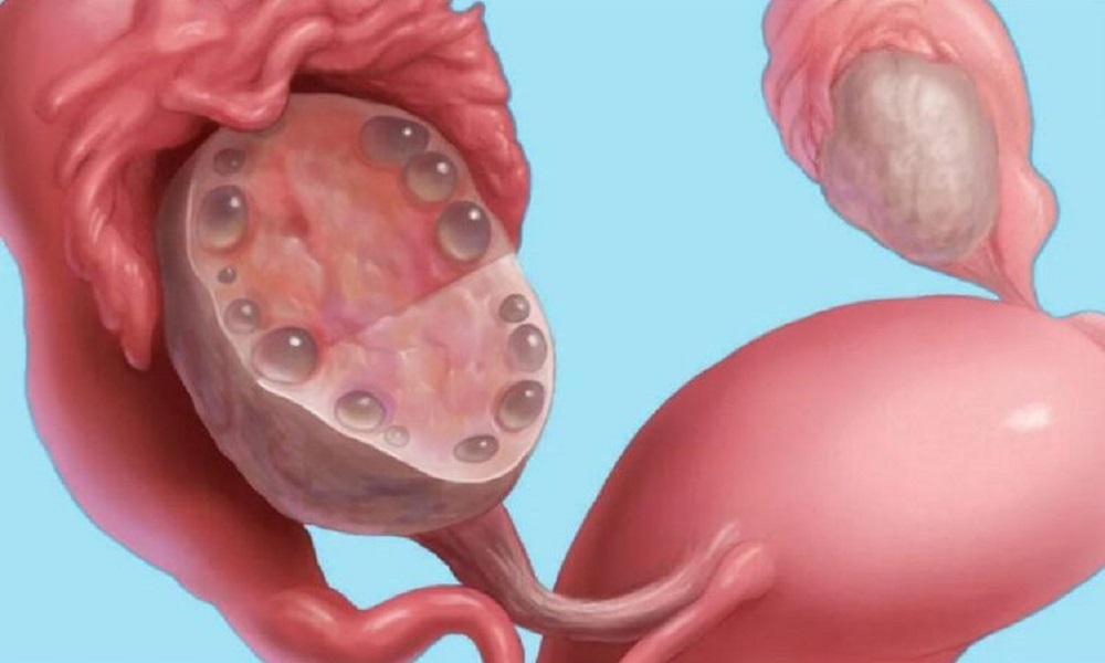 Managing Endometriosis Without Surgery