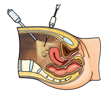 laparoscopy